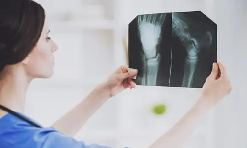 طبيب يعرض صور أشعة ليد وقدم مصاب في حادث سيارة