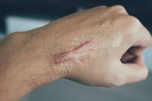 A man with a burn injury on his hand.
