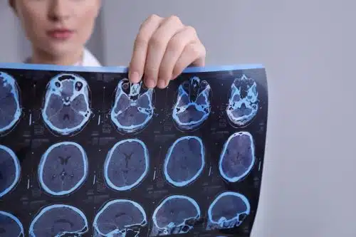 A female doctor reviews a MRI for a patient with seizures.
