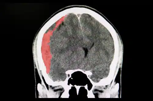 An MRI of a brain injury that caused memory loss.