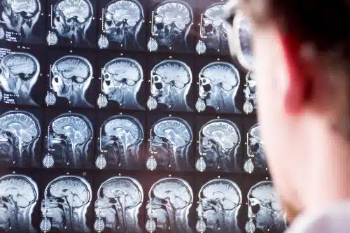 A doctor reviews an MRI after a brain injury.