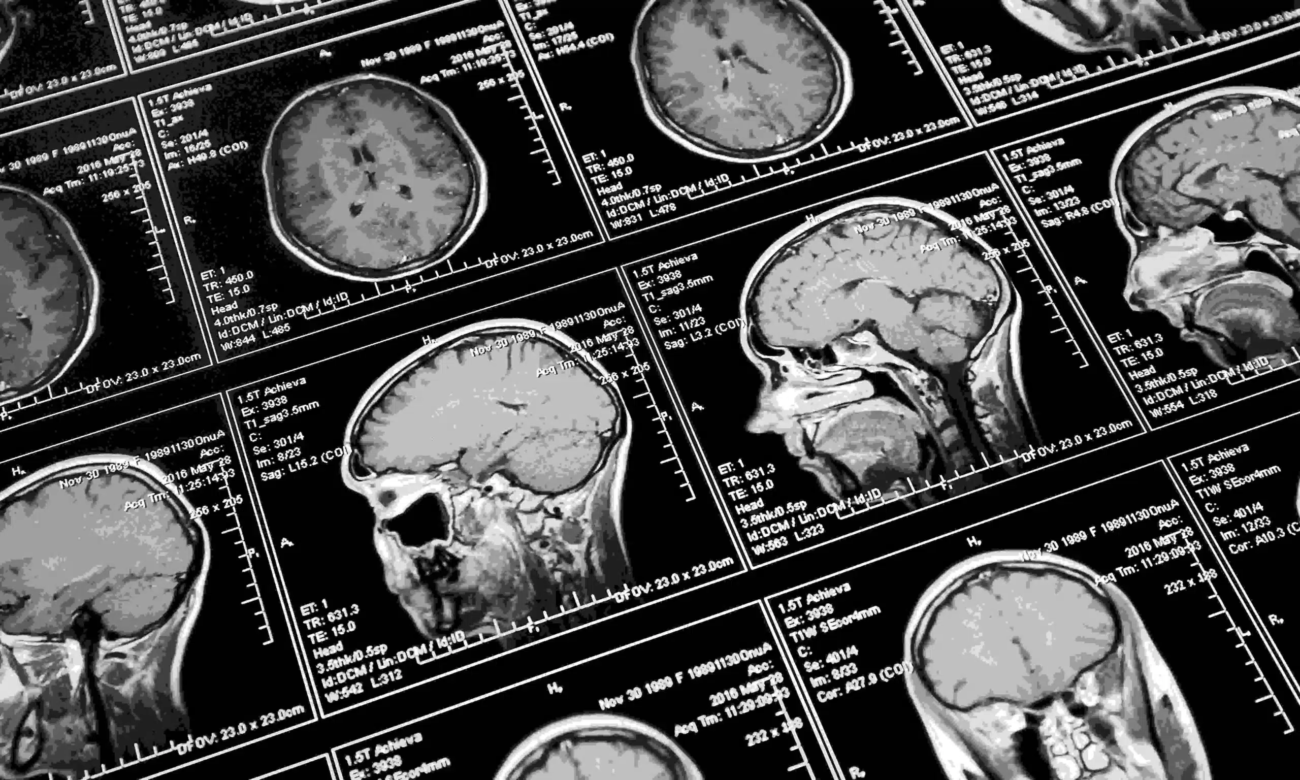 A closeup of an MRI scan of an accident victim's brain.