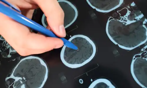 A doctor pointing with a ball point pen at a brain scan printed on paper.