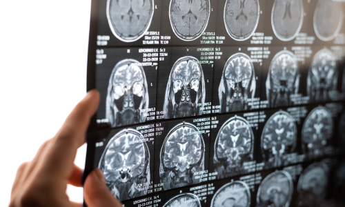 A doctor's hand holding up a patient's brain scan at a viewing lamp.