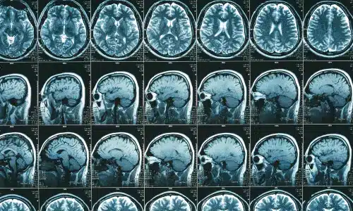 A brain scan of a TBI held against a viewing light.
