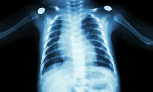 An x-ray of a newborn baby with medical devices in the shoulders.