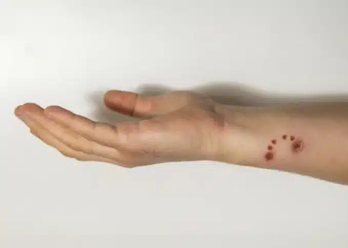 dog bite injury