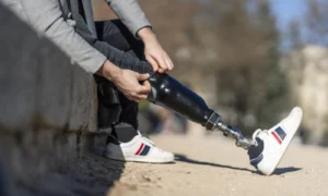 Amputation and Prosthetics: Lifetime Costs