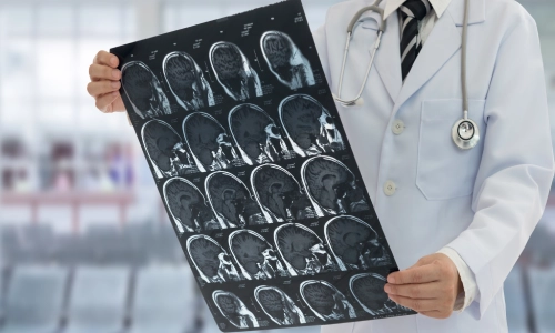 A doctor in a white coat and stethoscope holds a brain scan with multiple MRI images, symbolizing diagnosis and evaluation of a traumatic brain injury