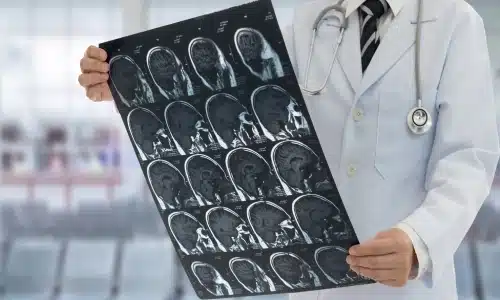 A doctor in a white coat holding and examining brain scan images, highlighting medical evaluation related to a brain injury.